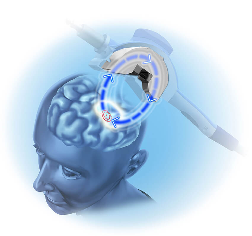 graphic of neurostar tms therapy